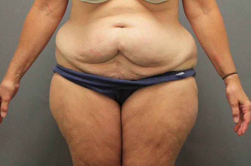 Before Abdominoplasty and Lip to thigh
