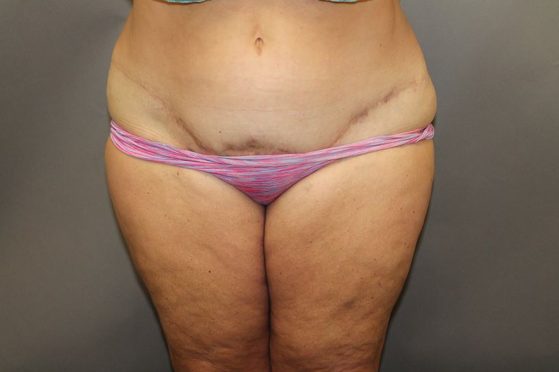 After Abdominoplasty and Lip to thigh