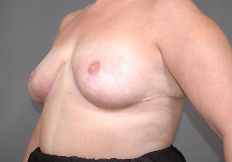 After breast reduction