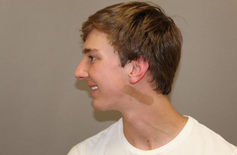 After chin implant