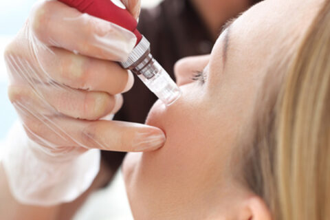 A women having a Microneedling treatment